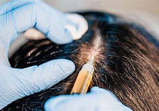 PRP for Hair Loss