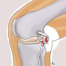 PCL Reconstruction Surgery