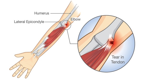 Tennis Elbow Release
