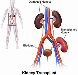 Kidney Transplant