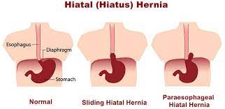 Laparoscopic Hiatal Hernia Repair
