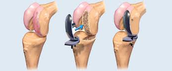 Joint Replacement (Arthroplasty)