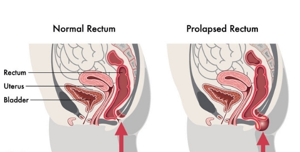Laparoscopic Rectal Prolapse Surgery 