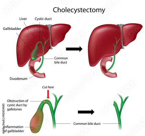 Side Effects of Gallbladder Removal