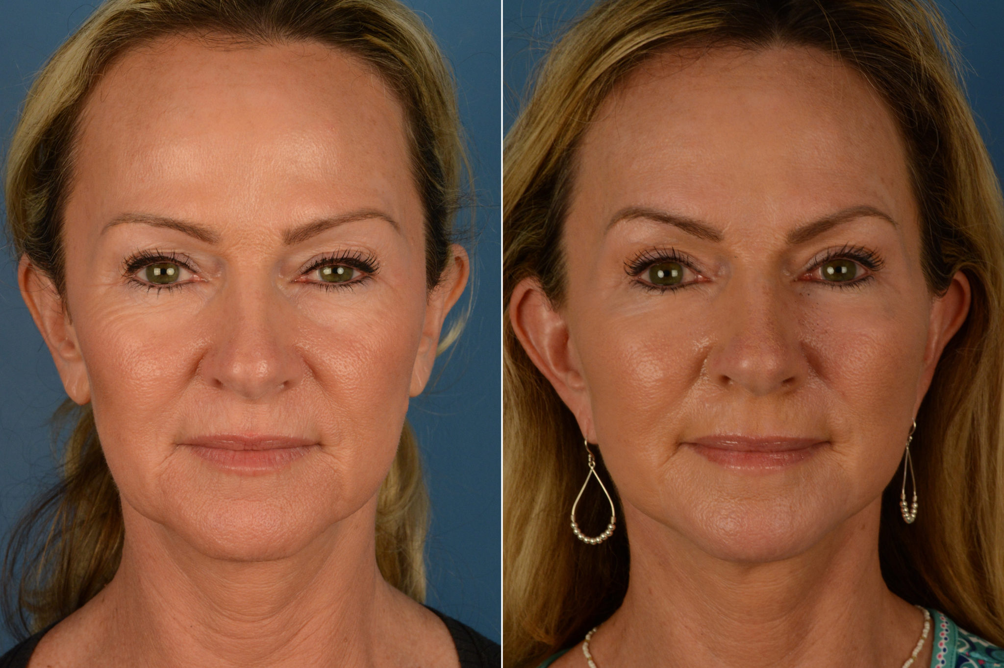 Facelift Surgery