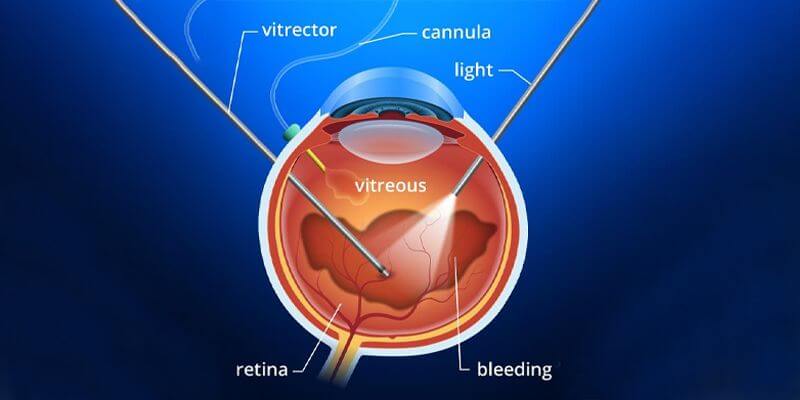 What is Vitrectomy? || image