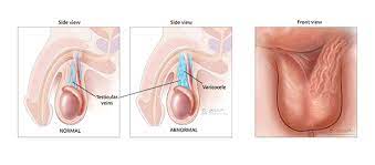 Varicocelectomy