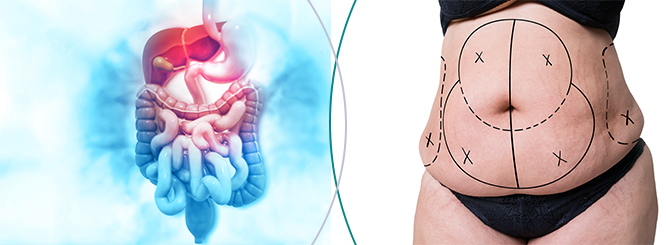 Bariatric Surgery and Liposuction: Are They the Same or Different?