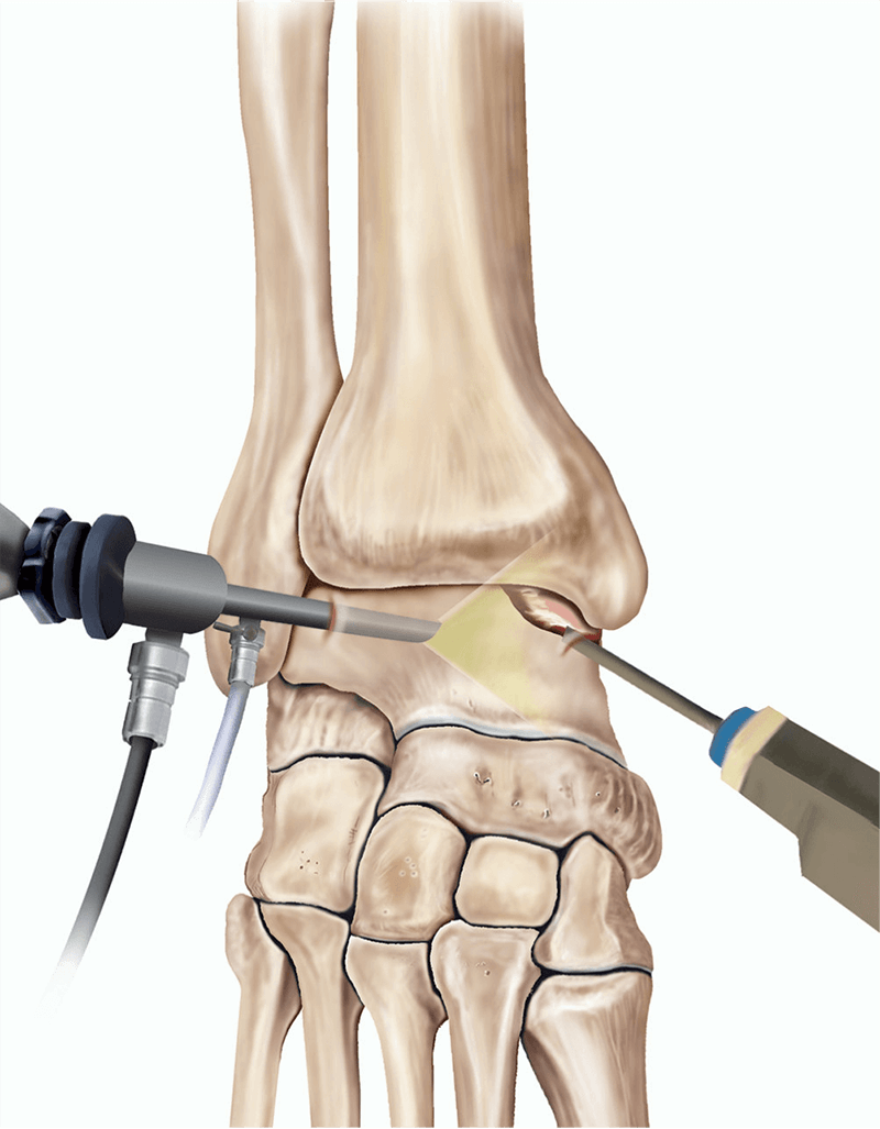 What is Ankle Arthroscopy? || image