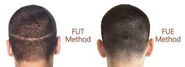 FUE vs FUT - Which is Best Hair Transplant?