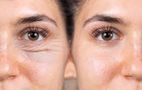 Eyelid Lift Surgery