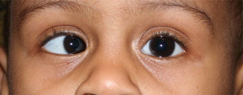 What is Strabismus? || image