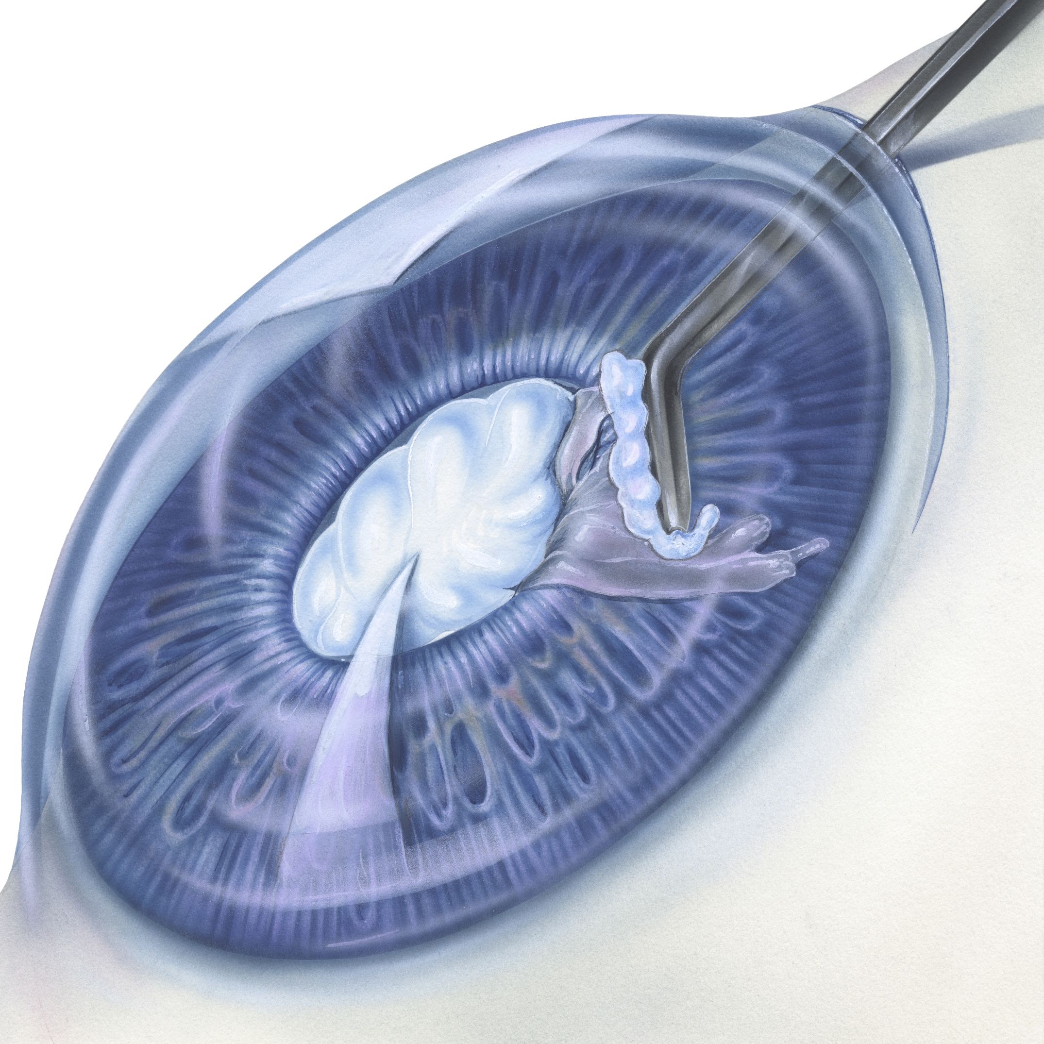 मोतियाबिंद के आंकड़े - Cataracts Statistics in Hindi