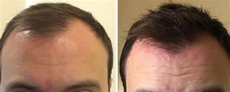 Hair Transplant