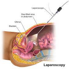 Laparoscopic procedure for  Hiatal Hernia || image