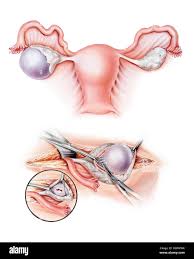 Laparoscopic Ovarian Cystectomy