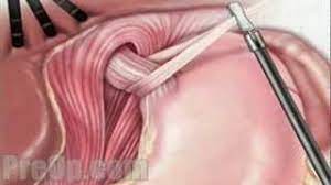 Hiatal Hernia || image