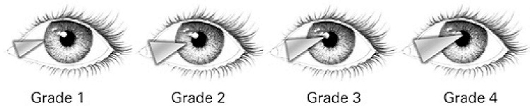 Pterygium Types || image