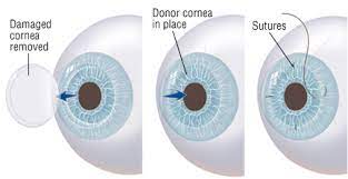 Cornea Transplant 