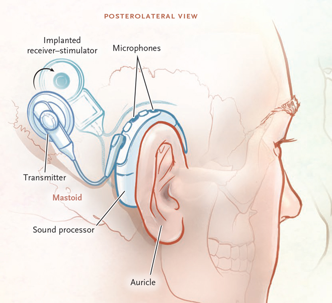 Cochlear Implant