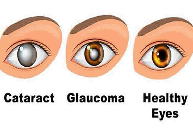 ग्लूकोमा और मोतियाबिंद में क्या अंतर है? - Glaucoma vs Cataracts in Hindi