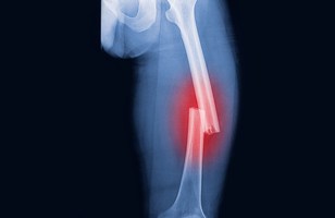What is Fracture? || image