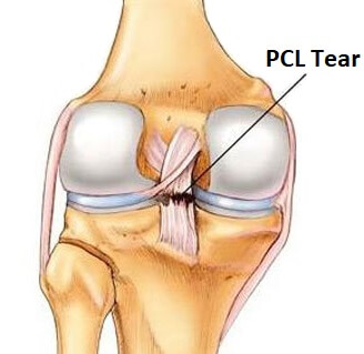 What is PCL Tear? || image