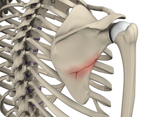 What are the Types of Shoulder Fracture? || image