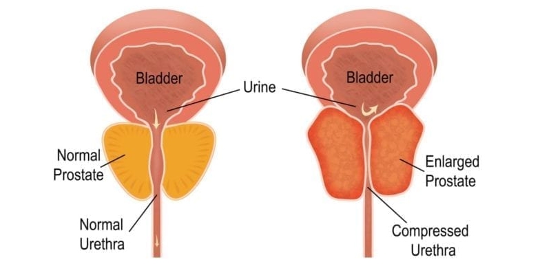 What is Enlarged Prostate? || image