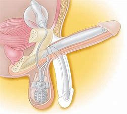 Penile Implant 