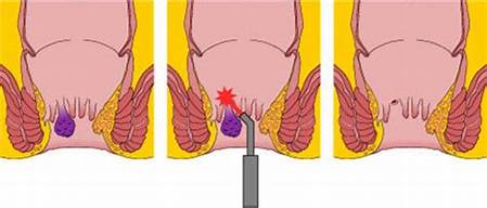 Laser to Cure Fissure A Boon