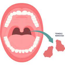Tonsillectomy