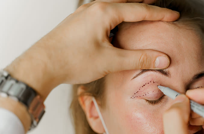 What is Ptosis Correction Surgery? || image