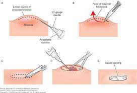 Incision & Drainage