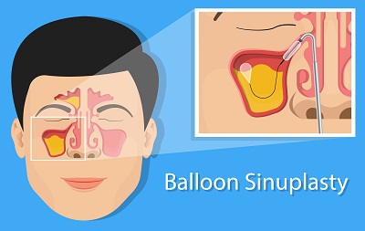 Balloon Sinus Ostial Dilation (Balloon Sinuplasty)