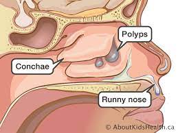 Polyp Removal Surgery (Polypectomy)