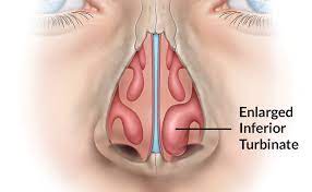 Turbinate Reduction Surgery