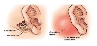 Mastoidectomy