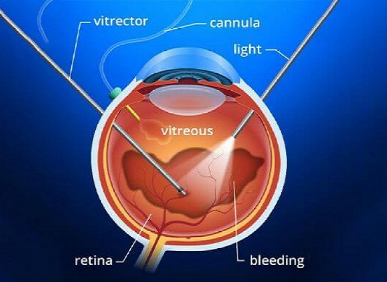Retinal Detachment Treatment || image