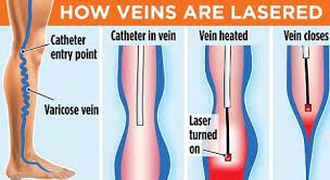 Laser Treatment for Varicose Veins