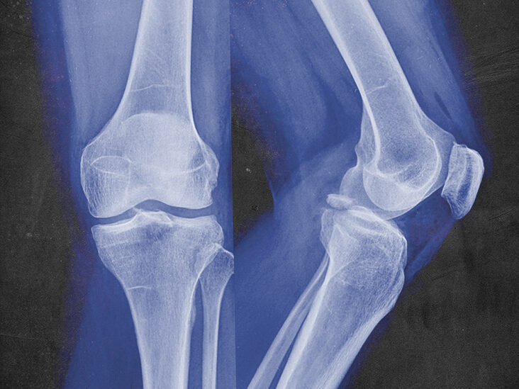 What is Fracture Treatment? || image