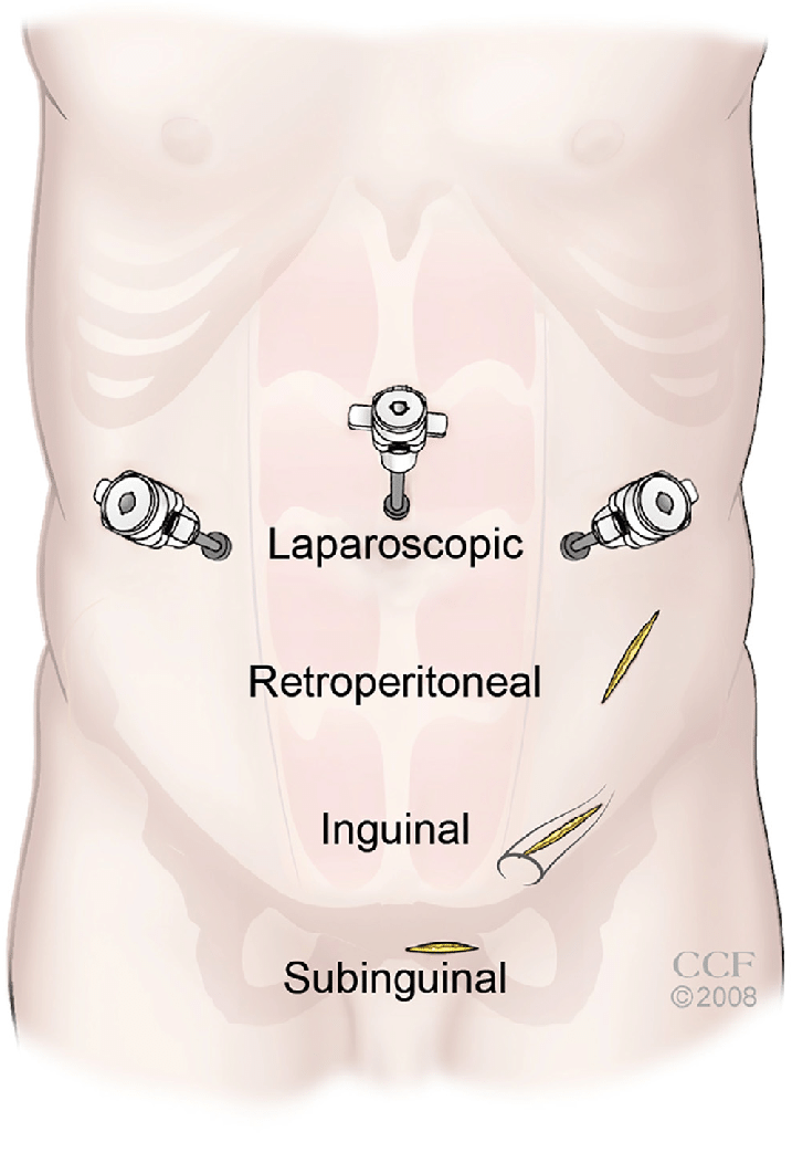 Varicocelectomy procedure || image