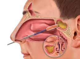 Functional Endoscopic Sinus Surgery (FESS)